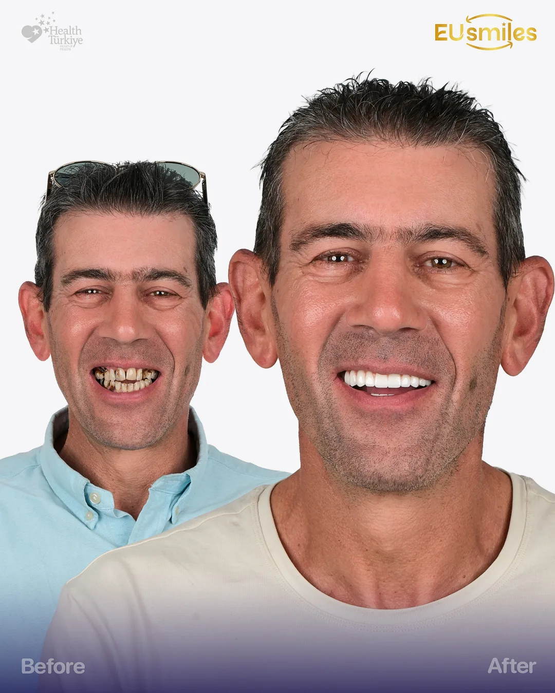 Anthony P. — Dental Veneers