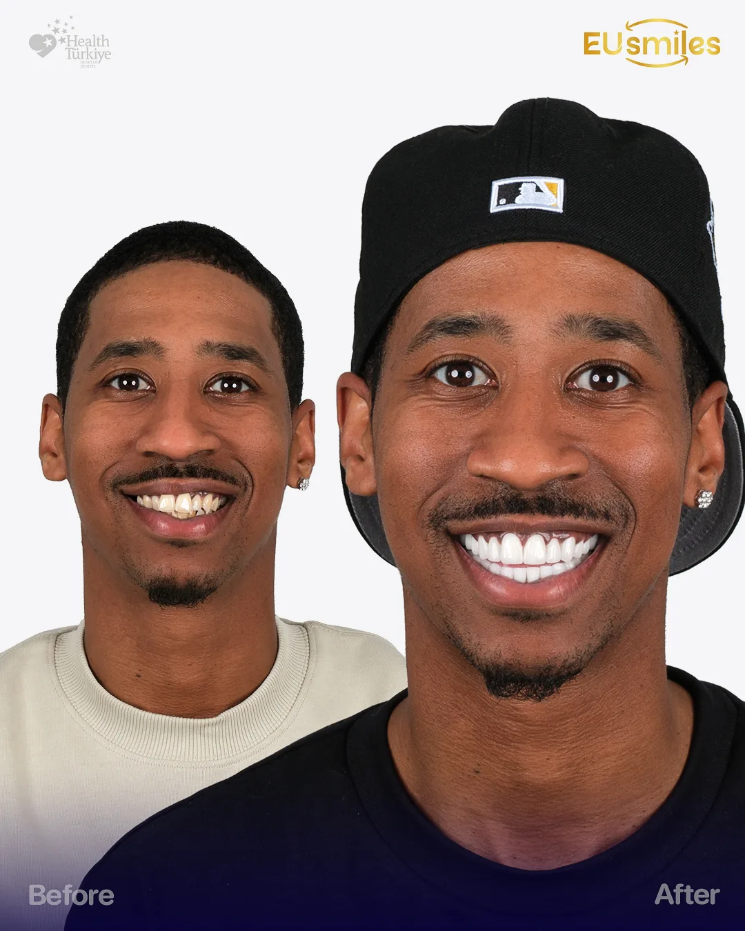 Jean Larry — Dental Implants