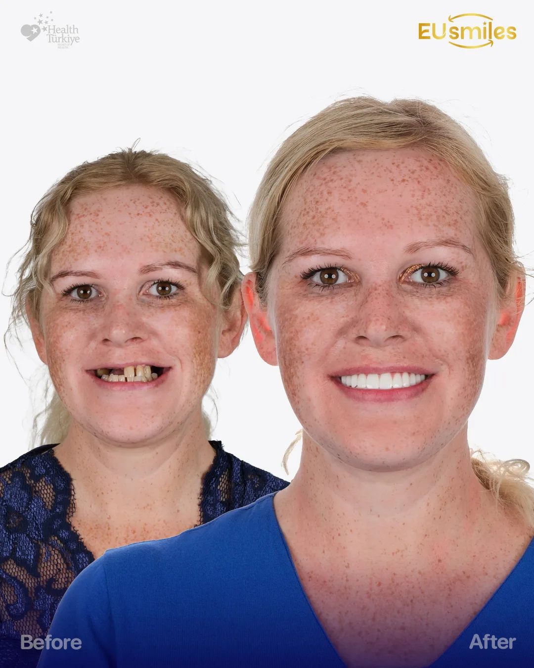 Jekatarina S. — Dental Veneers