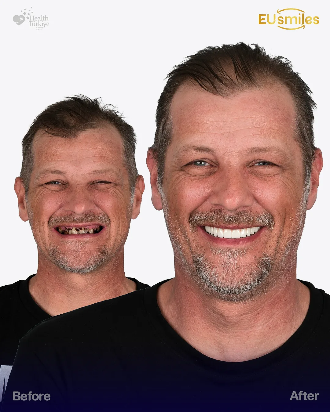 Mathiass K. — Zirconium Crowns