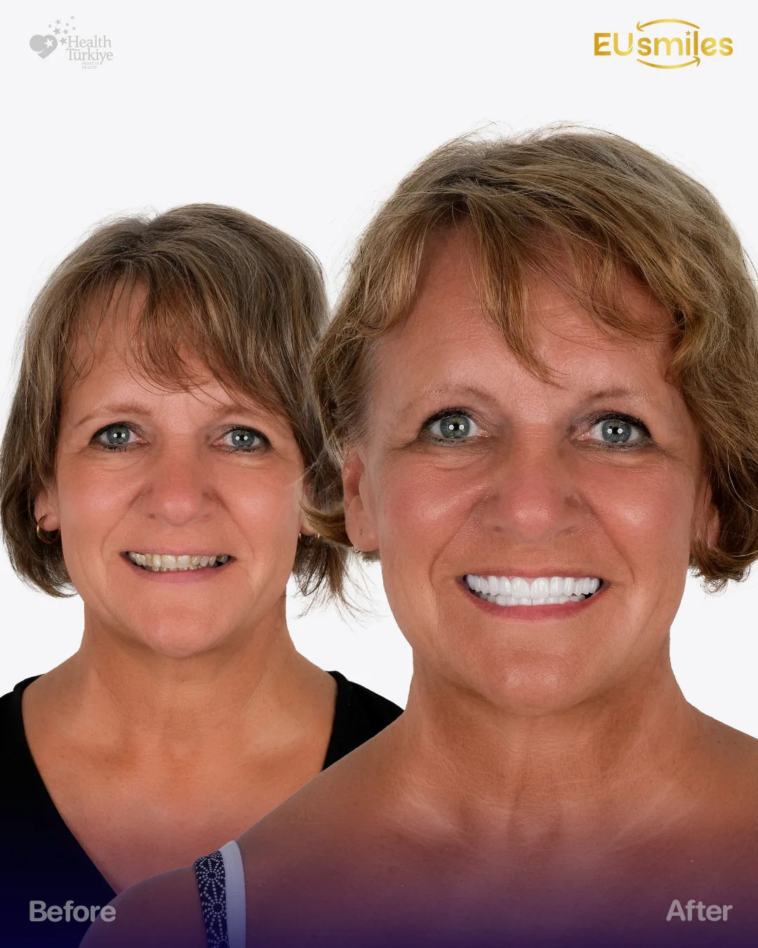 Tine L. — All-on-4 Implants