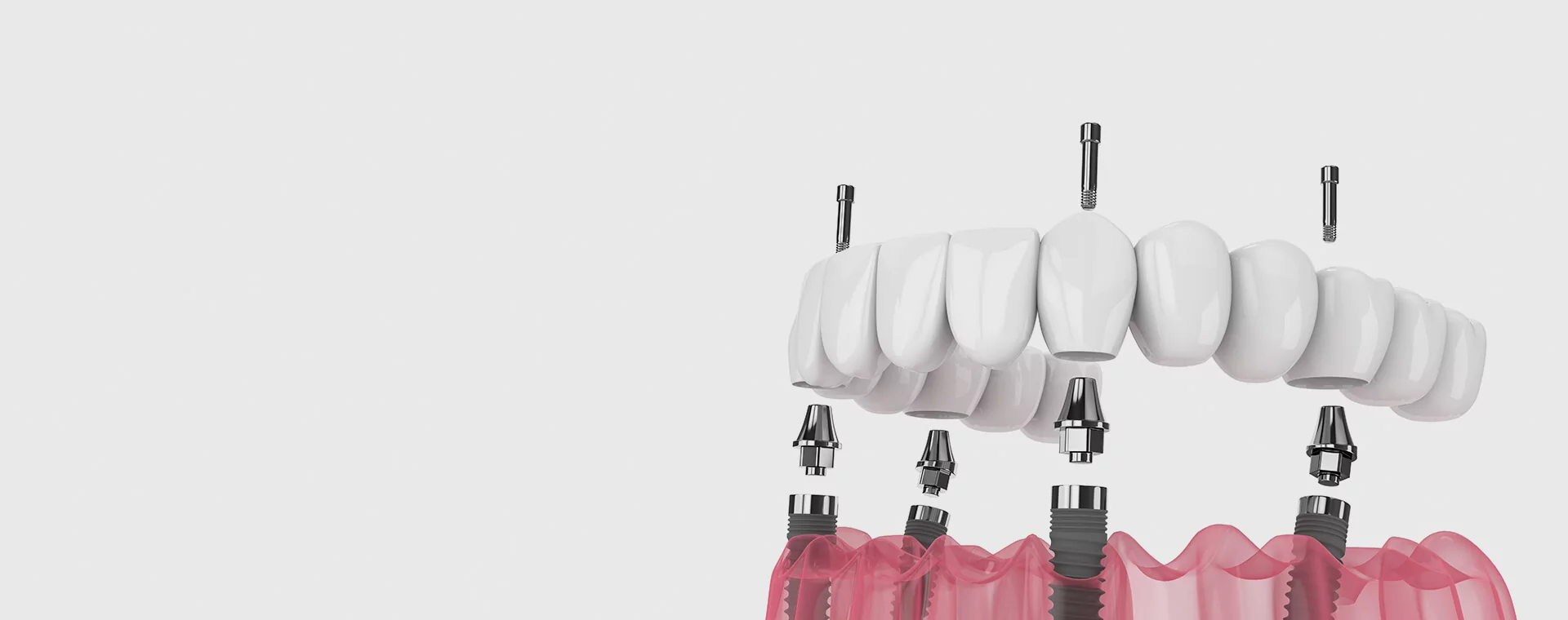 Dental Implants in Antalya