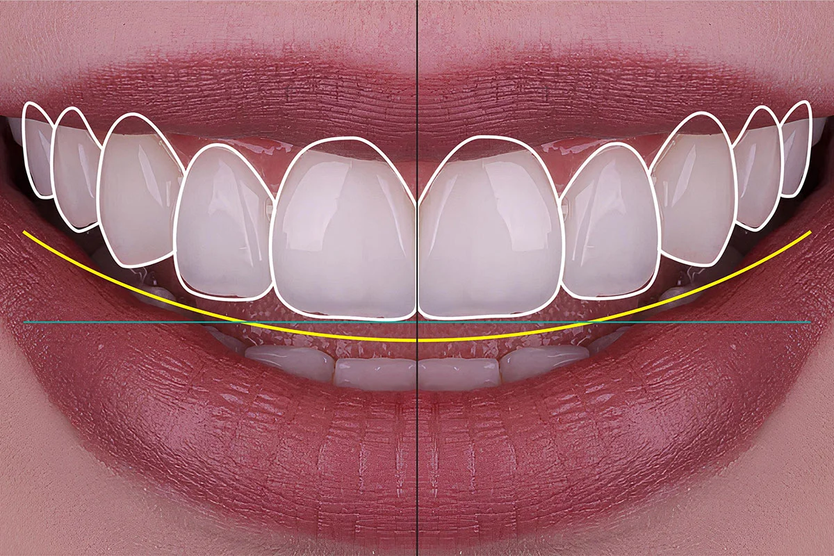 Smile design consultation at EUSmiles