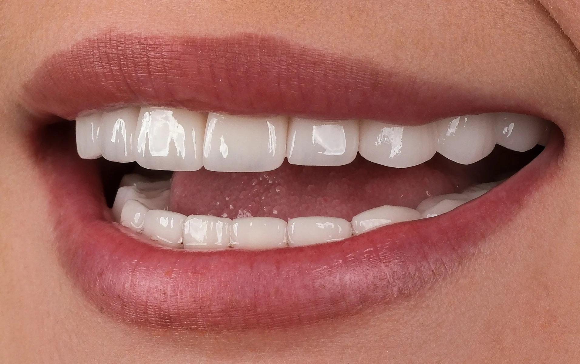 Dental Implants after