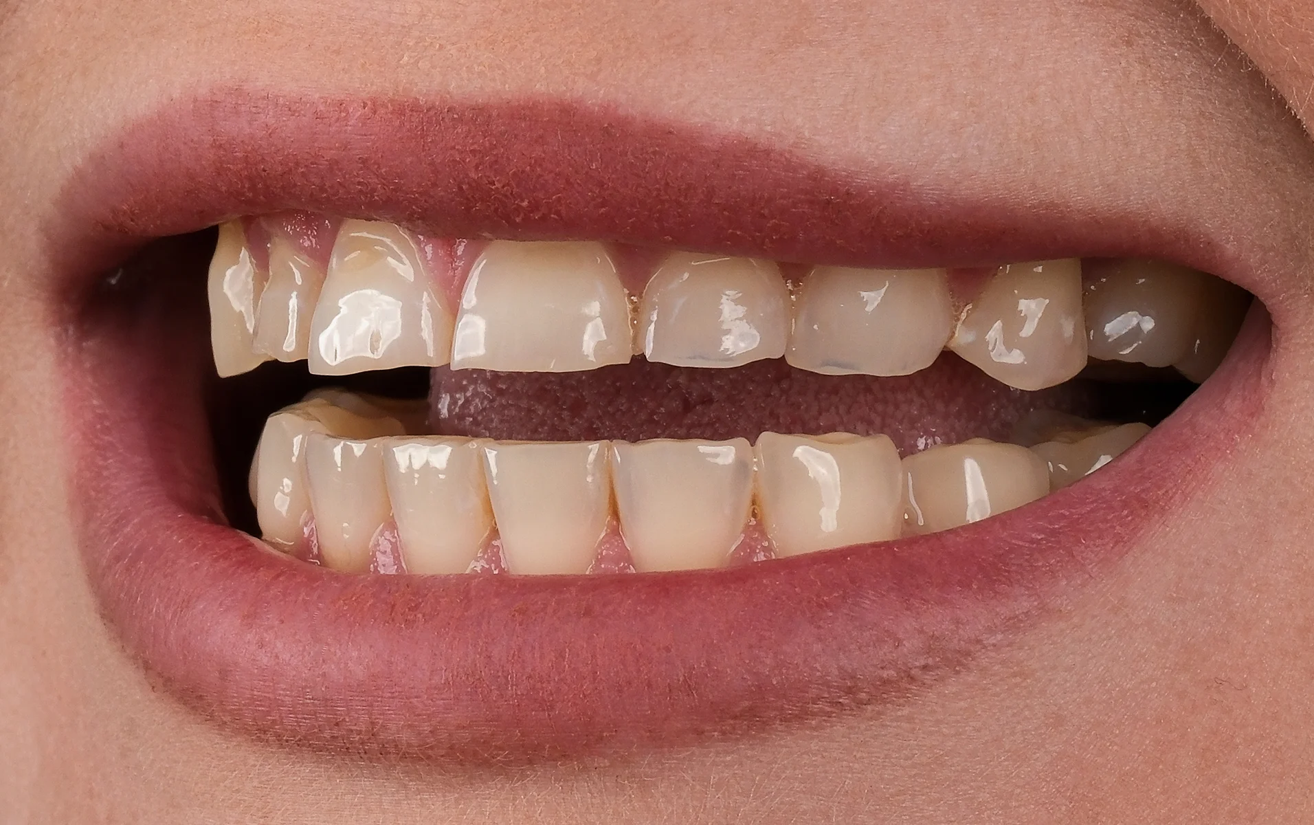 Dental Implants before