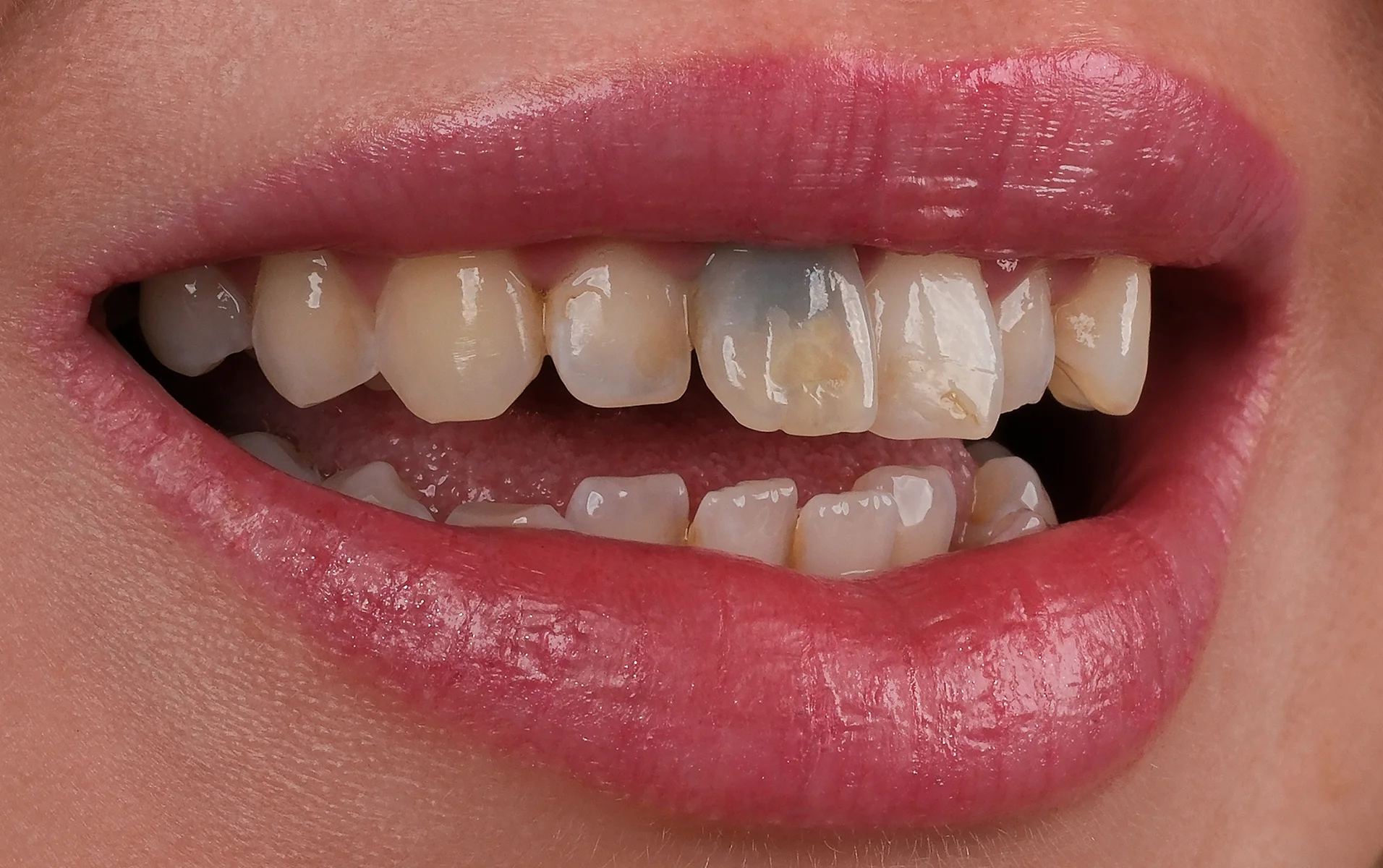 Teeth Whitening before