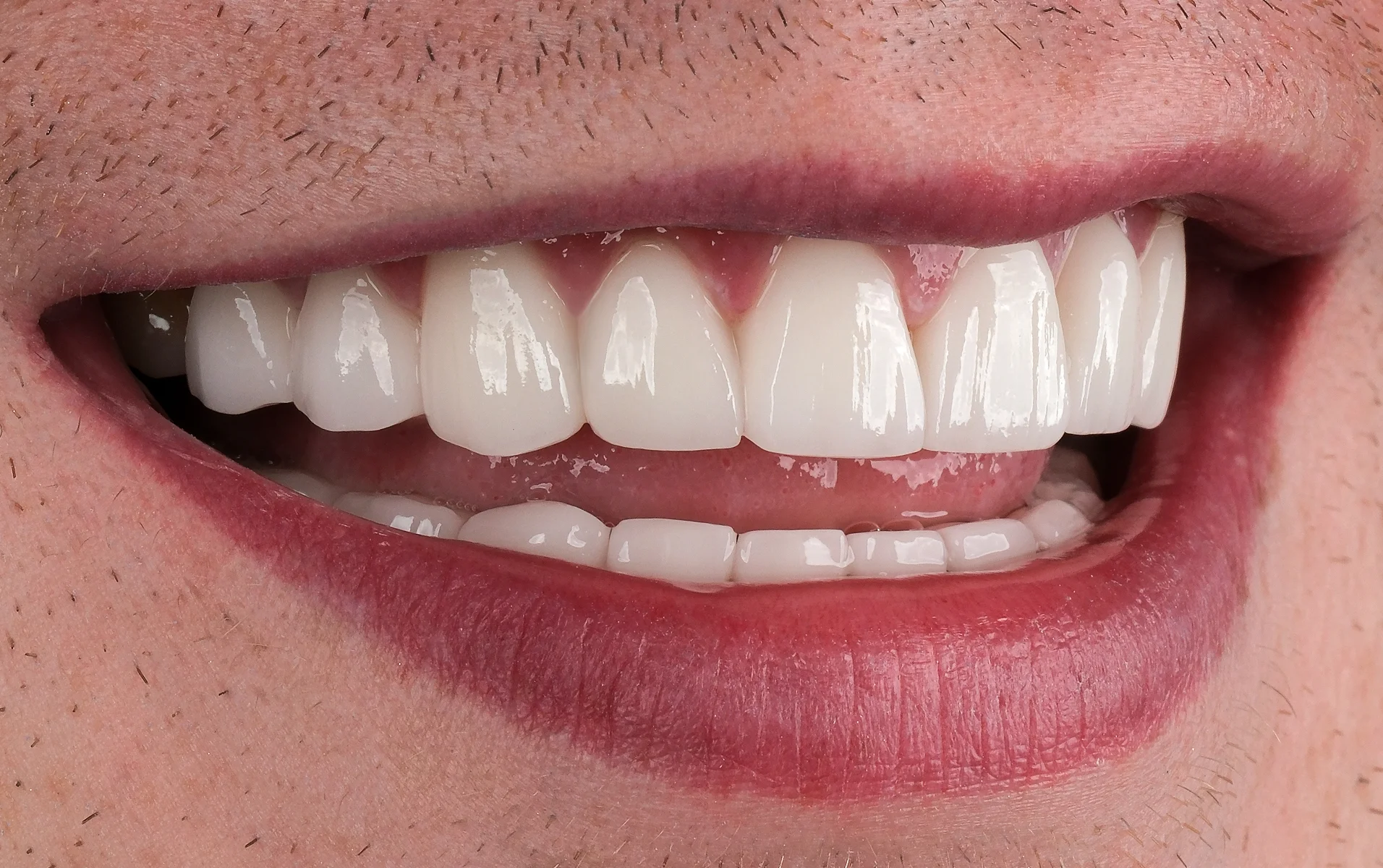 Porcelain Veneers after