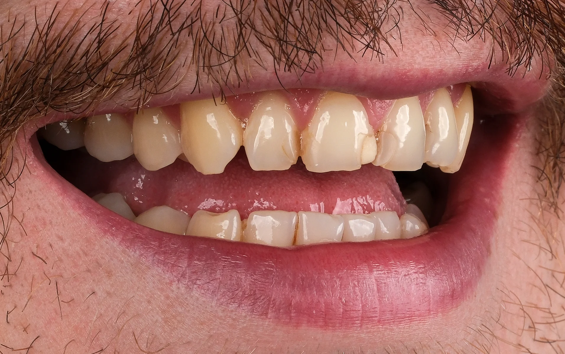 Porcelain Veneers before