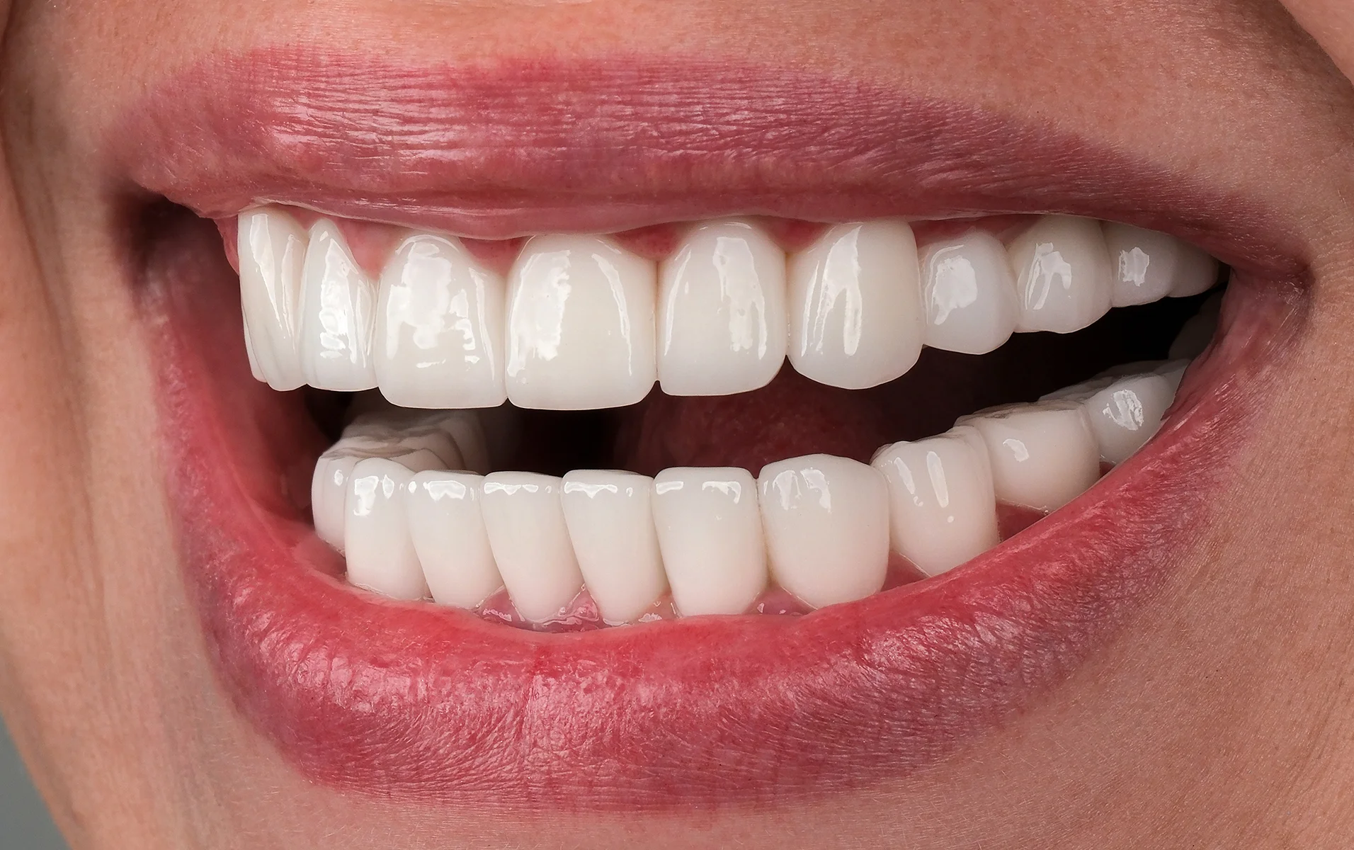 Full Smile Makeover after