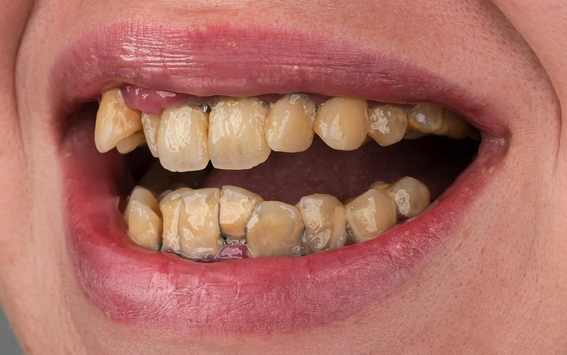 Full Smile Makeover before