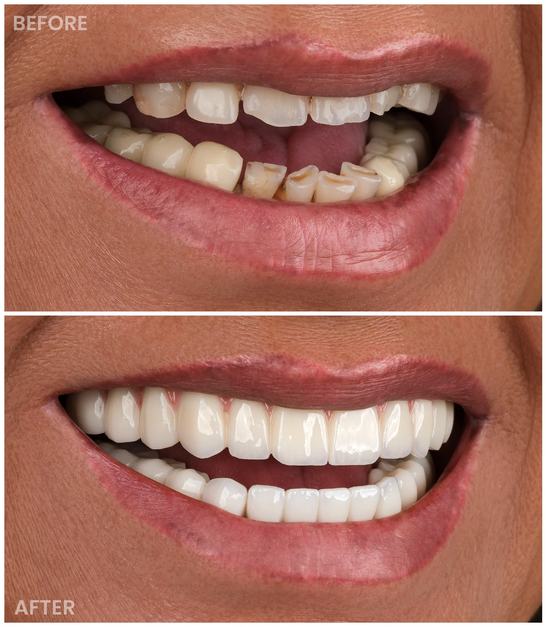 Dental Implants result