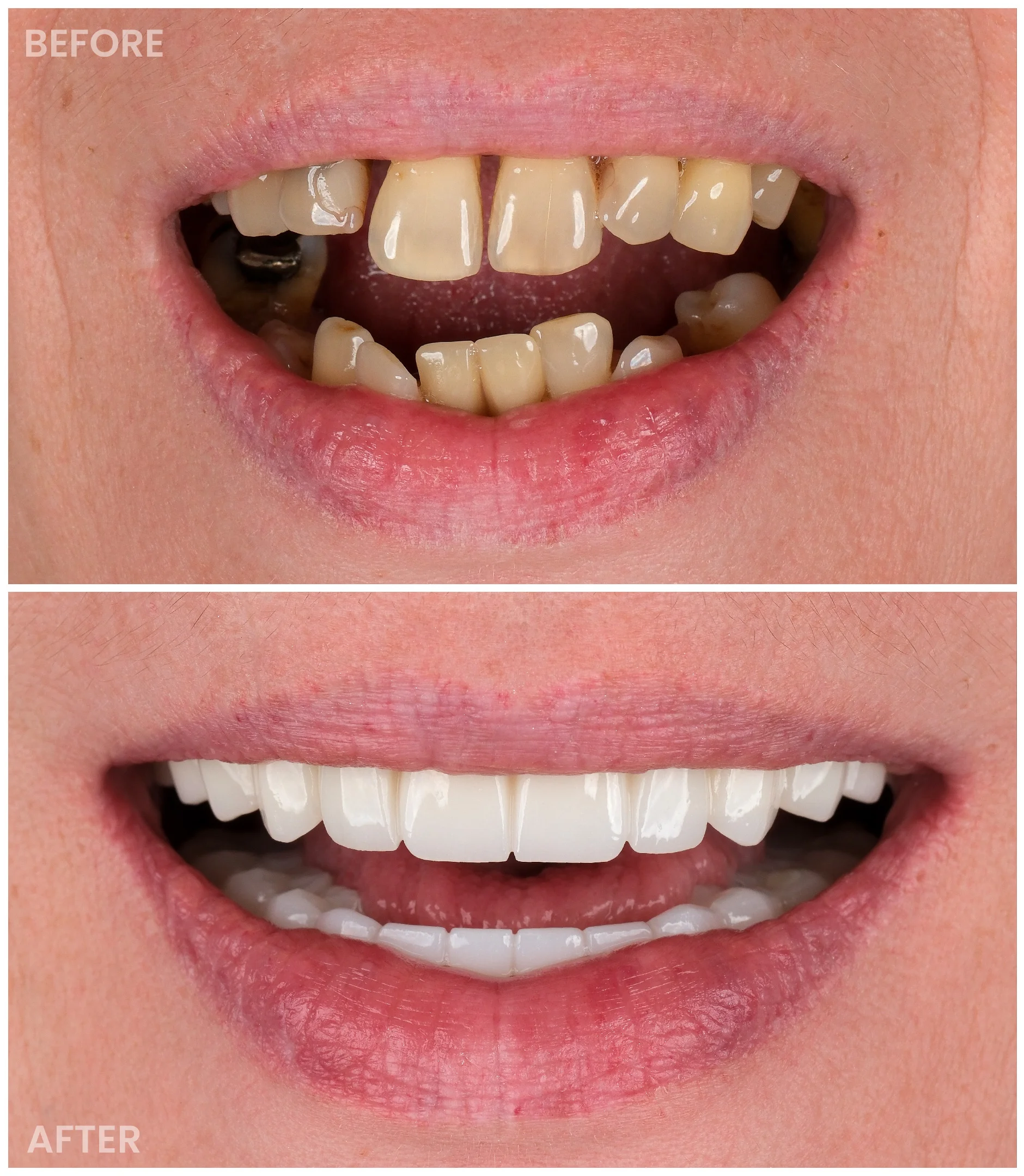 Dental Implants result