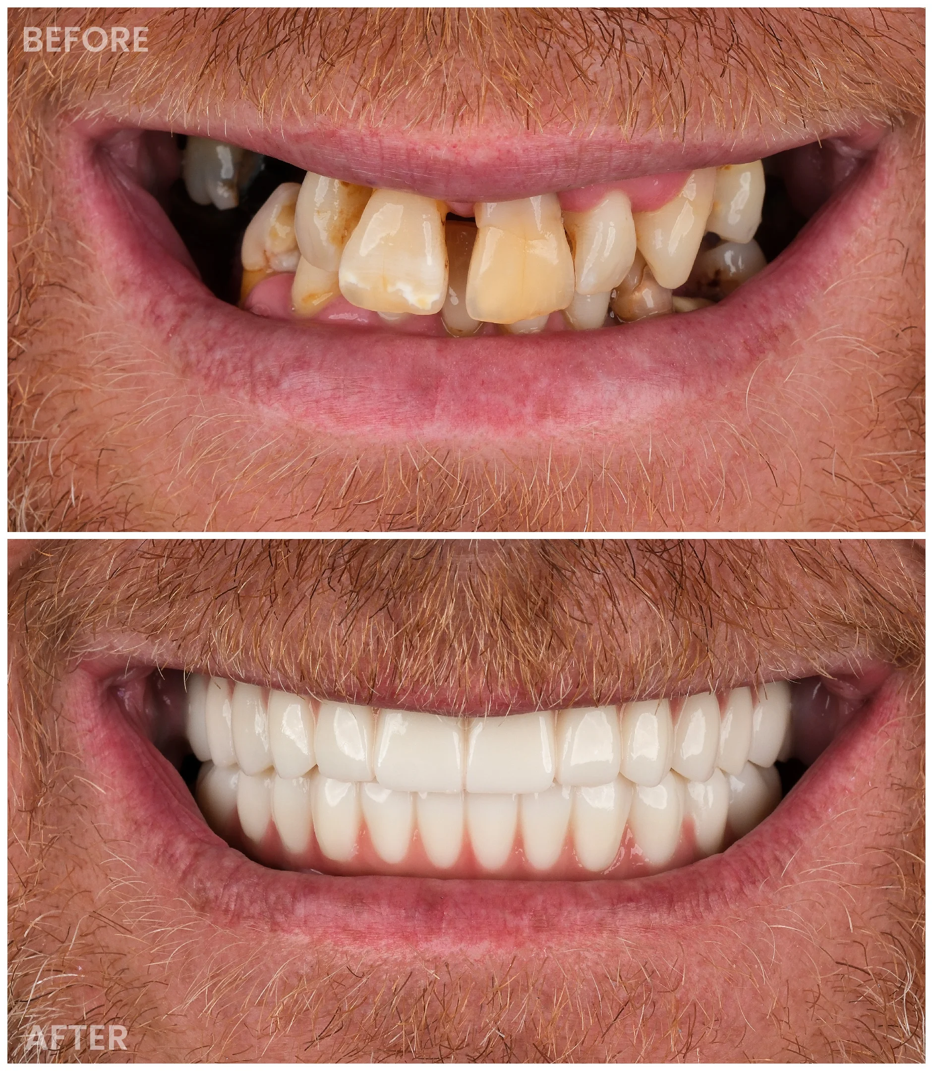 Dental Implants result