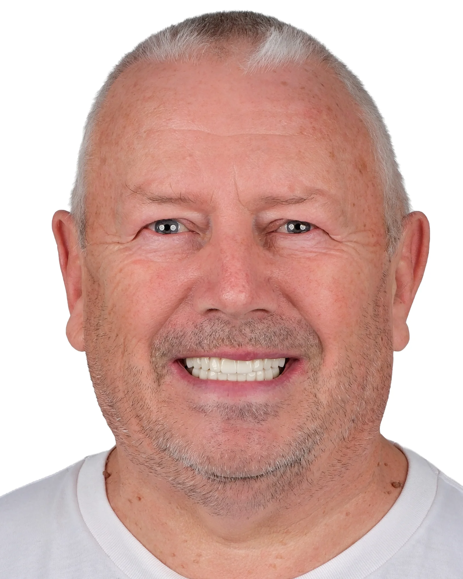 Hollywood Smile · Veneers After