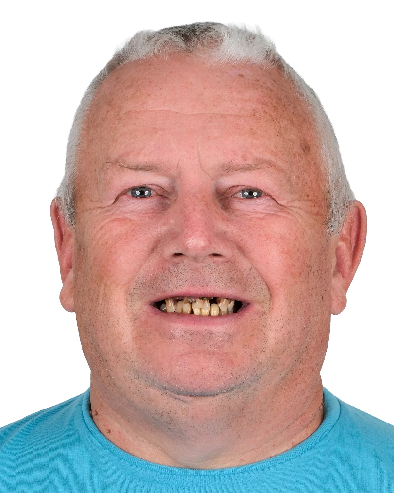 Hollywood Smile · Veneers Before