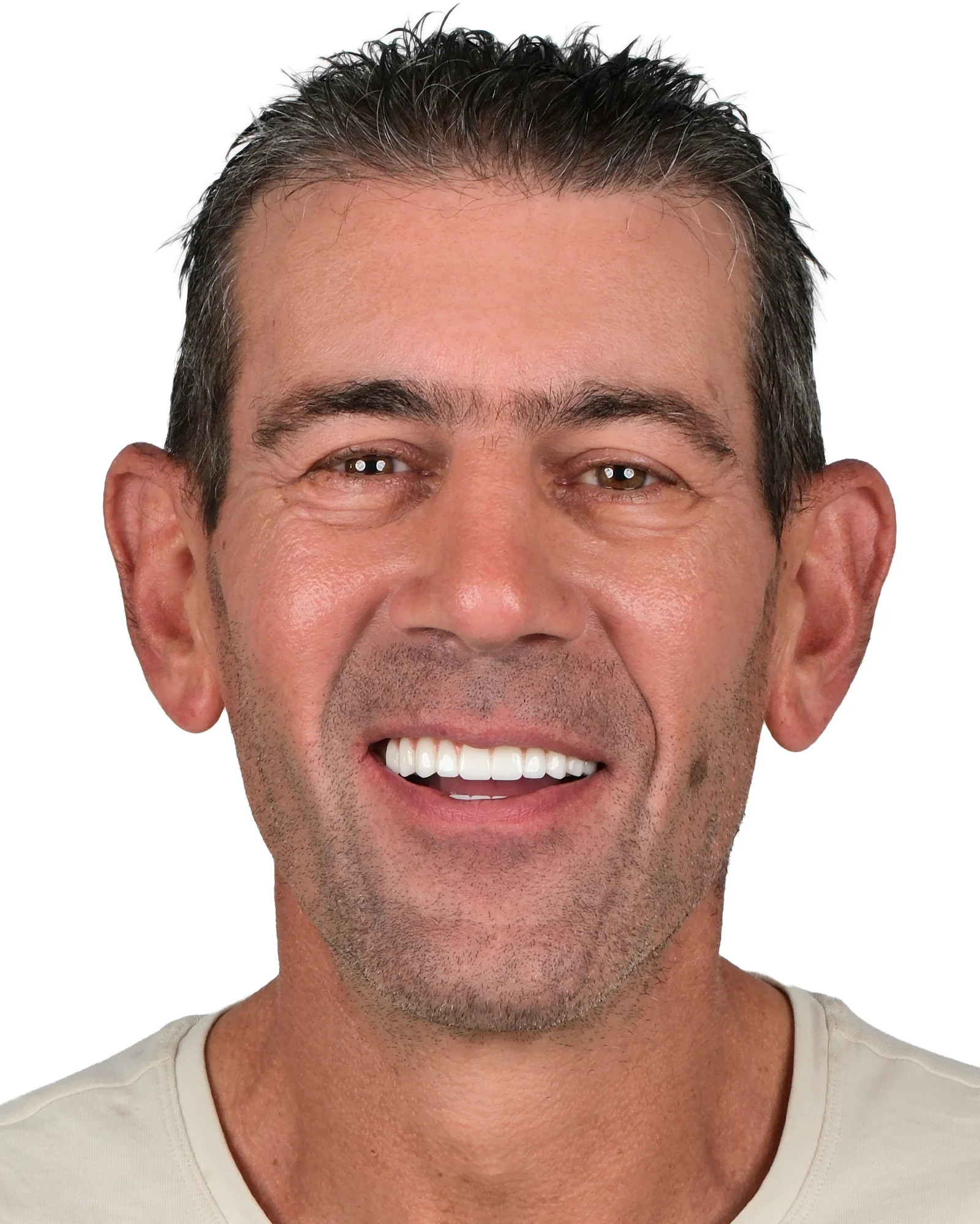 Zirconium Crowns After