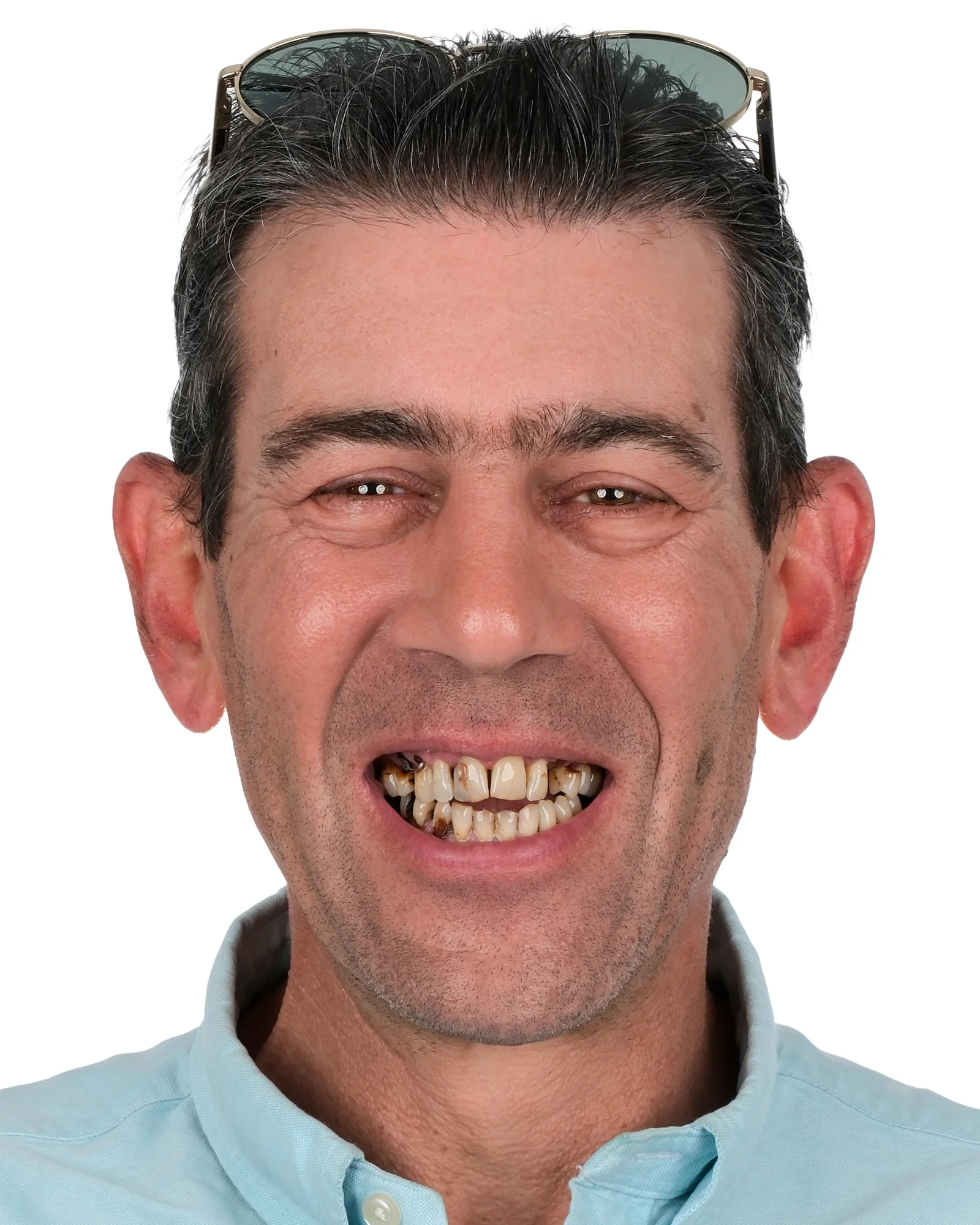 Zirconium Crowns Before