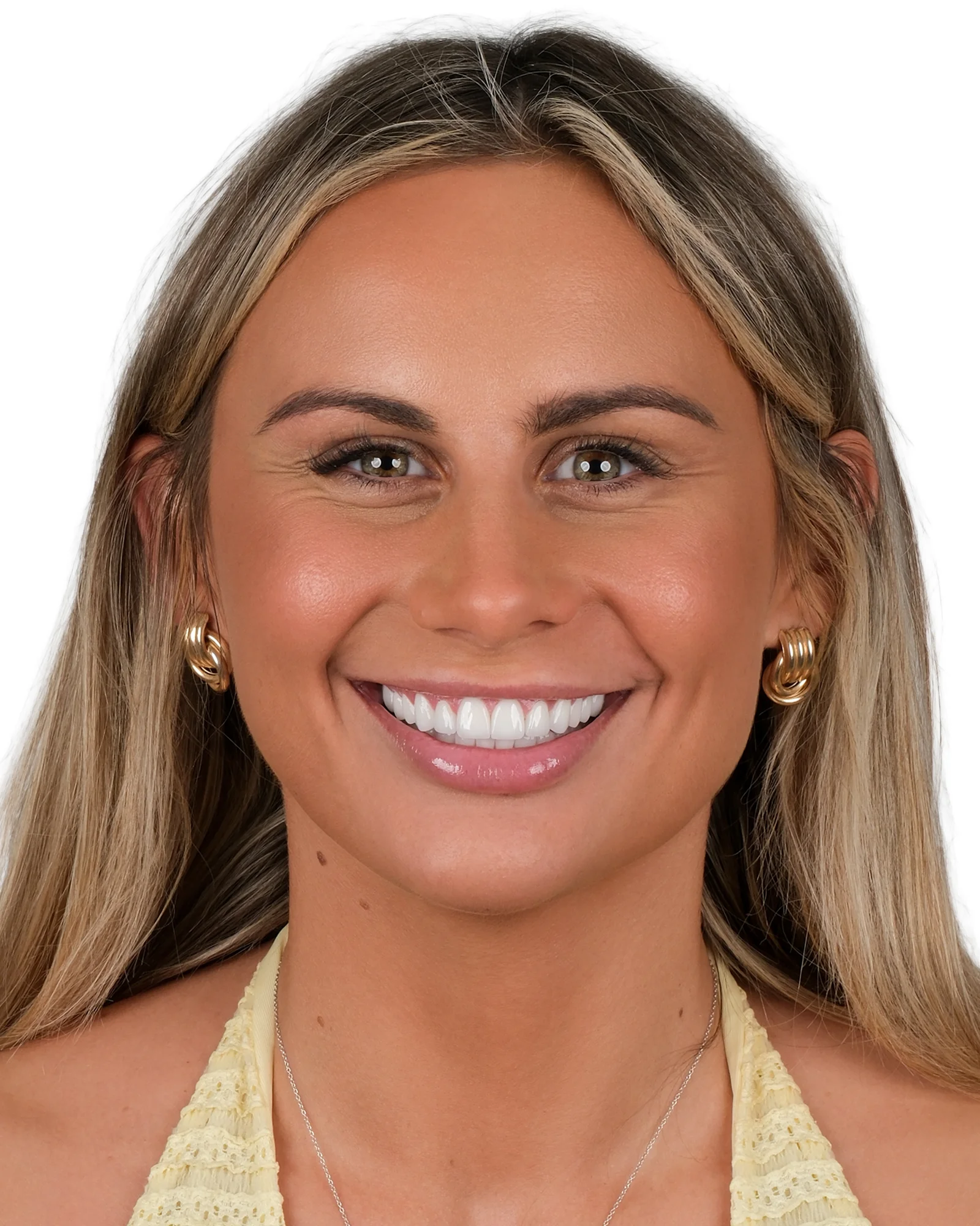 Smile Makeover After