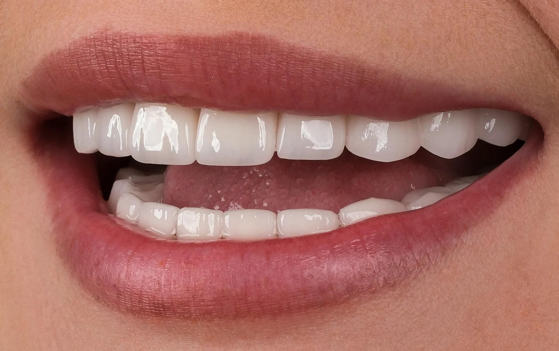 Smile Makeover After