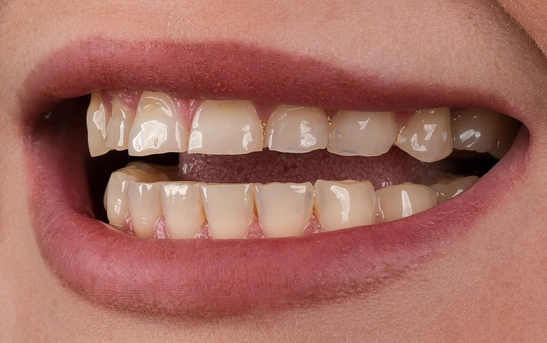 Smile Makeover Before