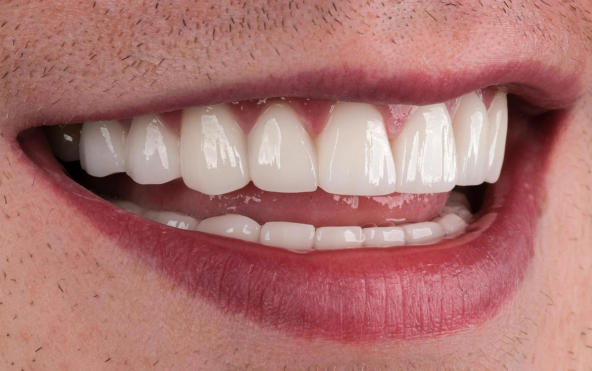Smile Makeover After