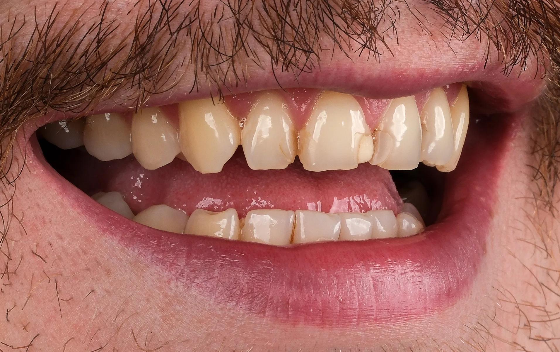 Smile Makeover Before