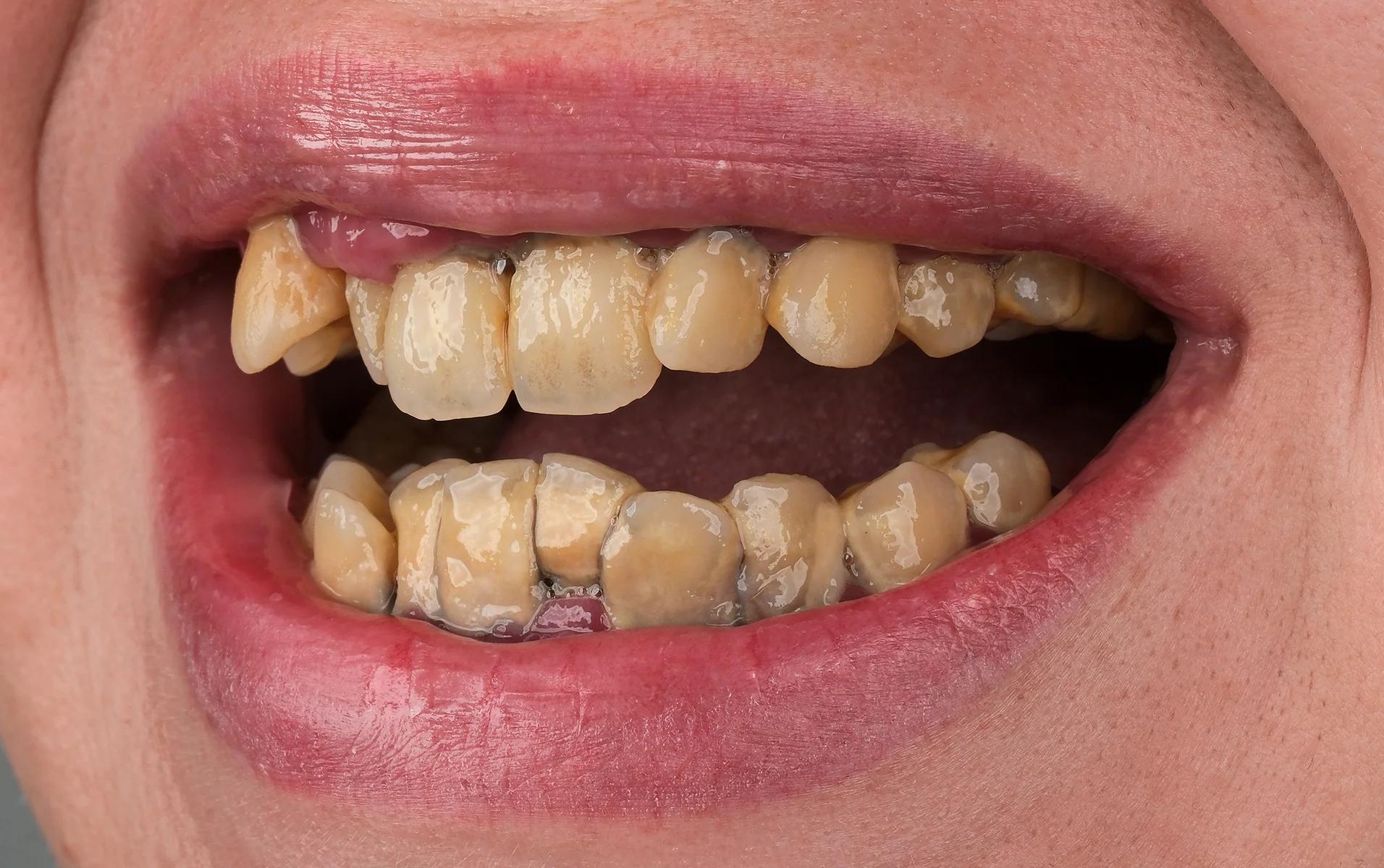 Smile Makeover Before