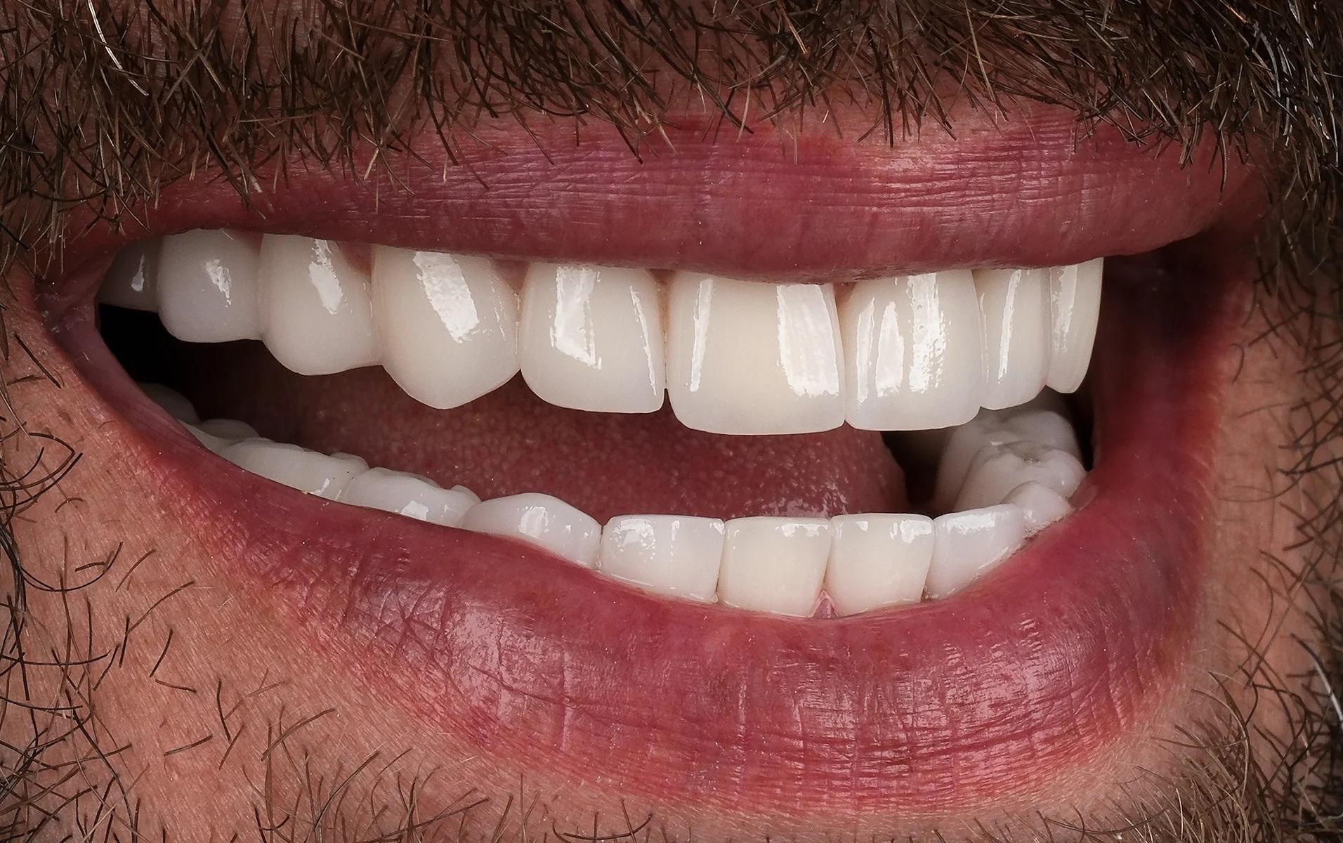 Zirconium crown before and after results — After