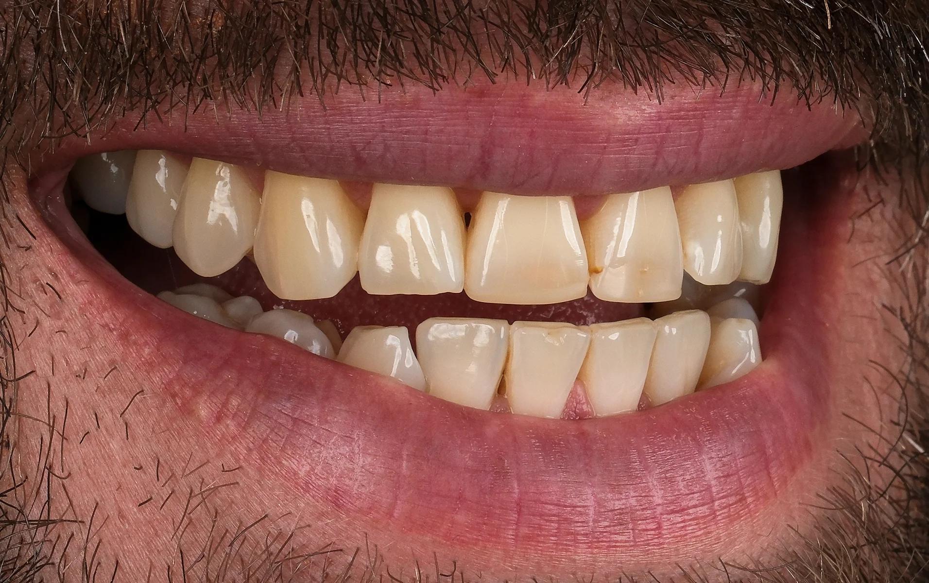 Zirconium crown before and after results — Before