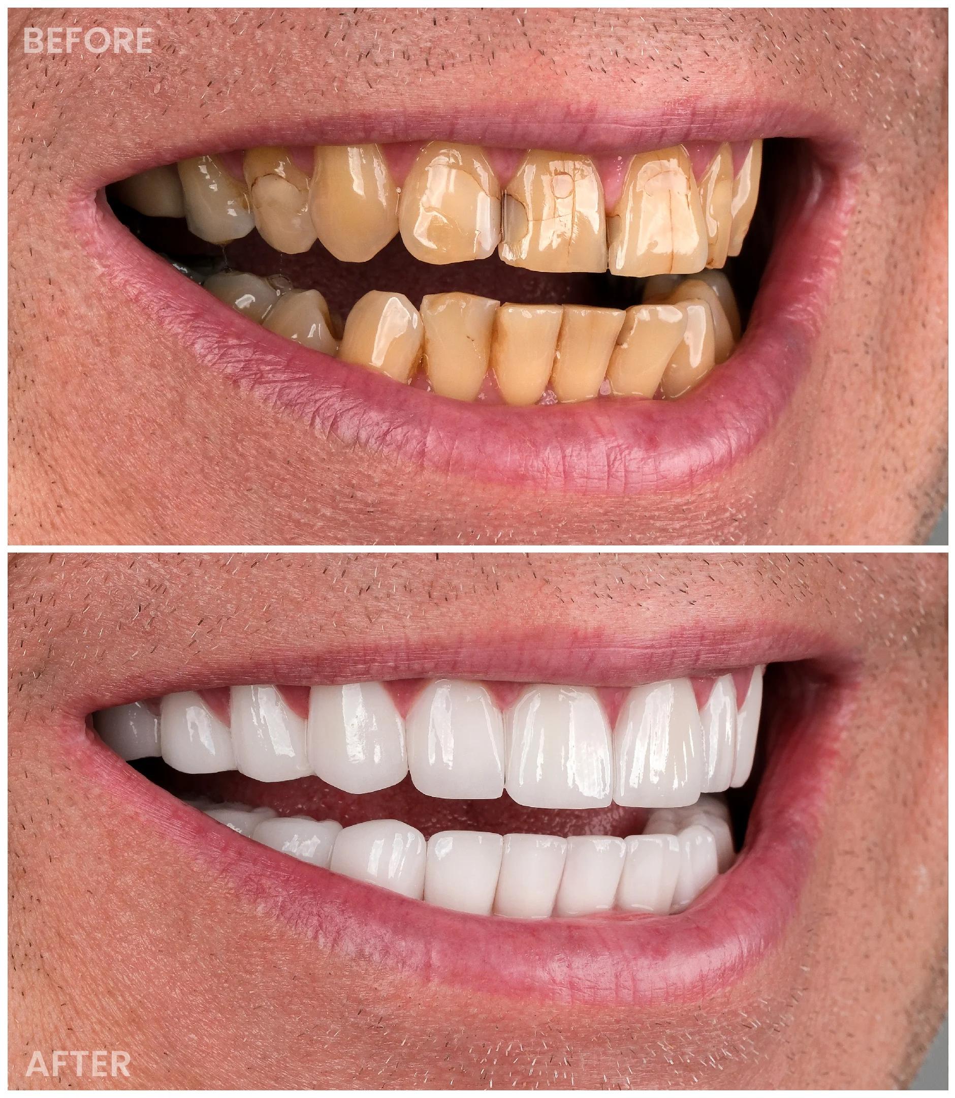 Smile Makeover