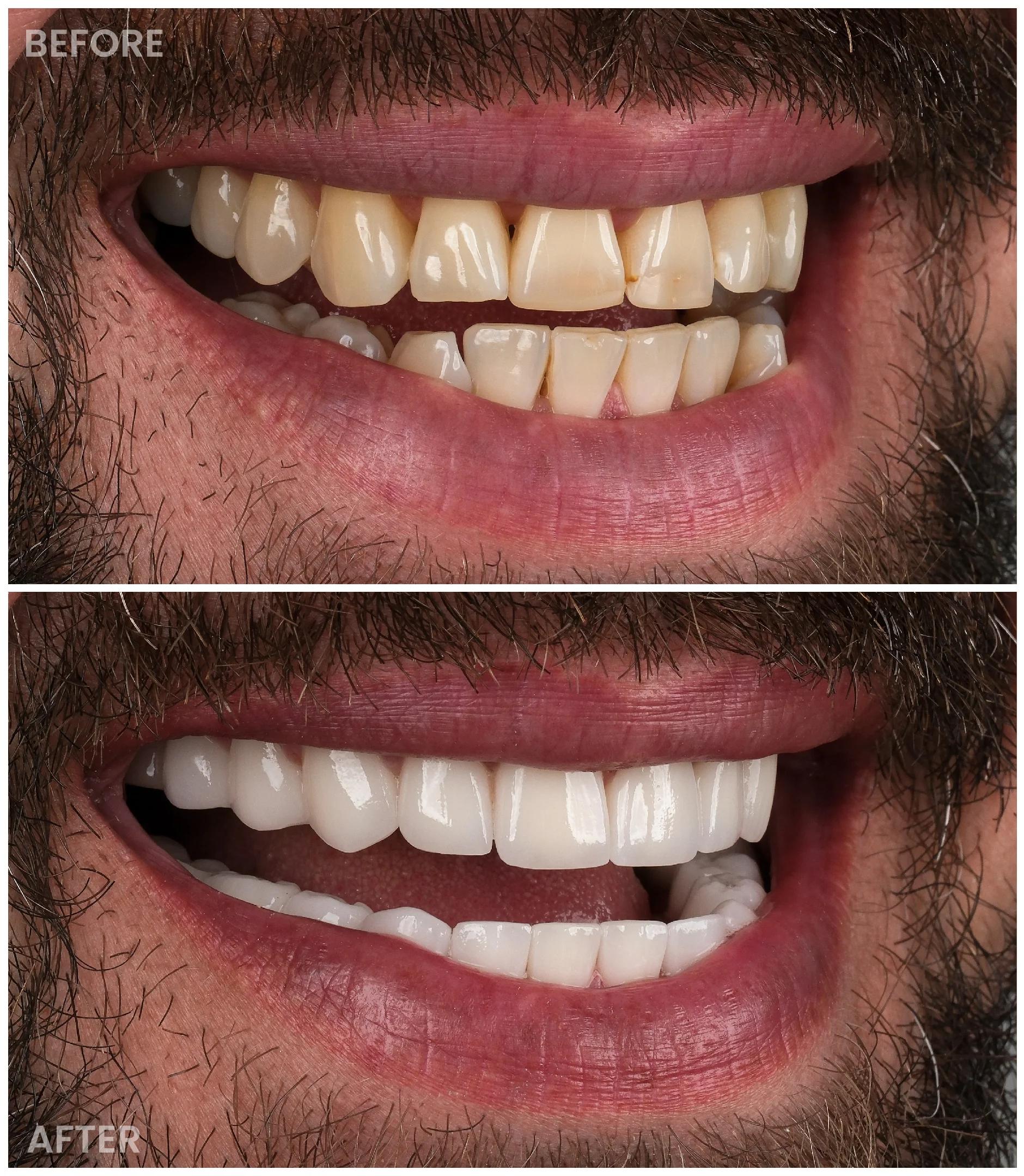 Smile Makeover