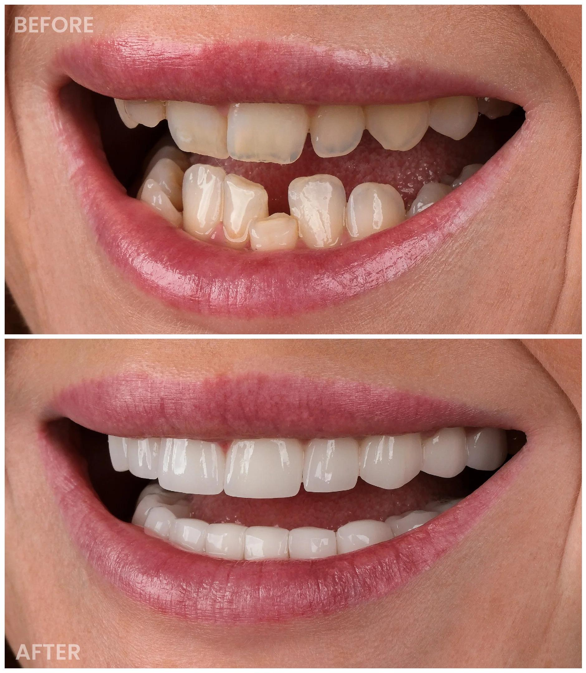 Smile Makeover