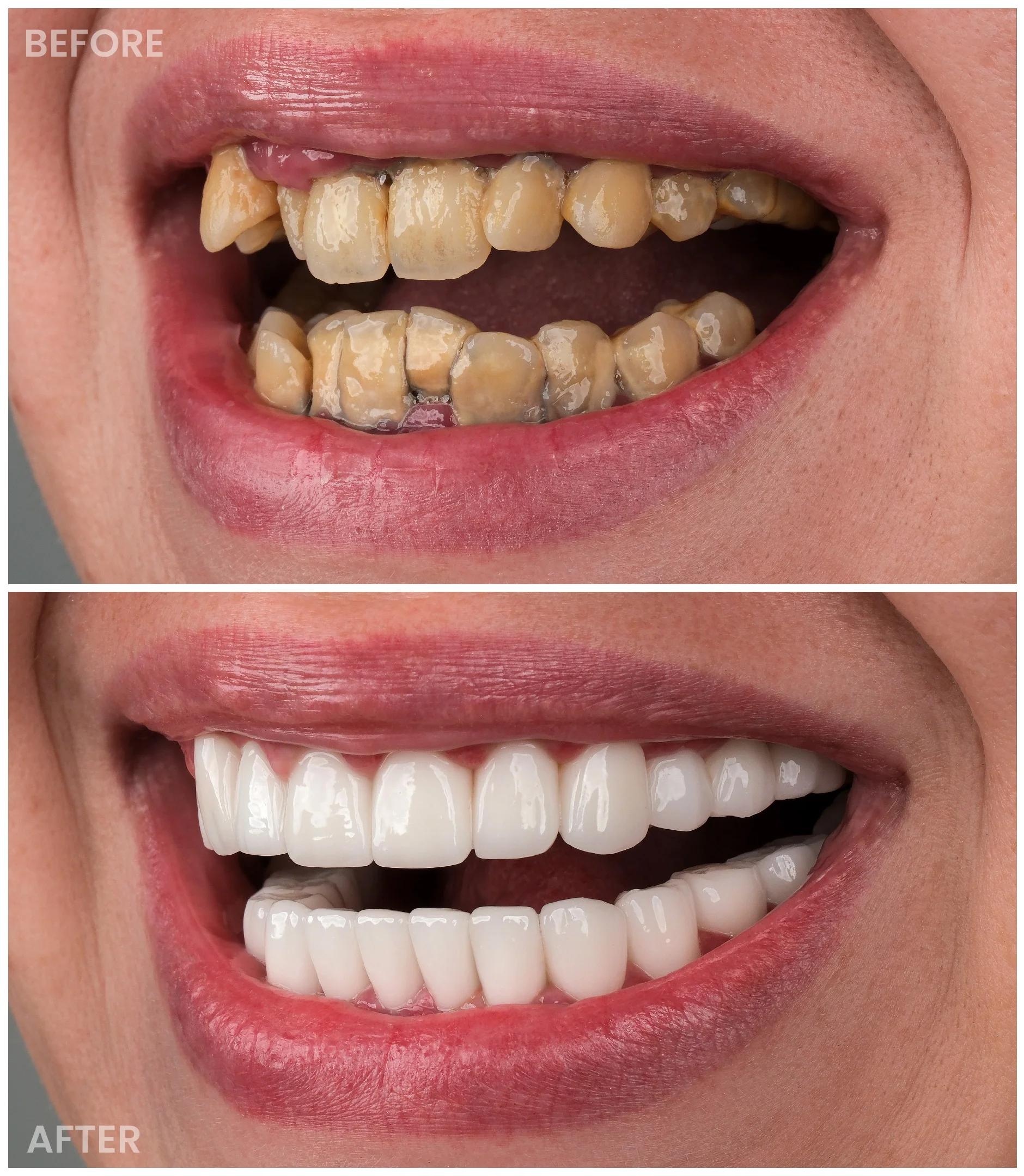 Smile Makeover