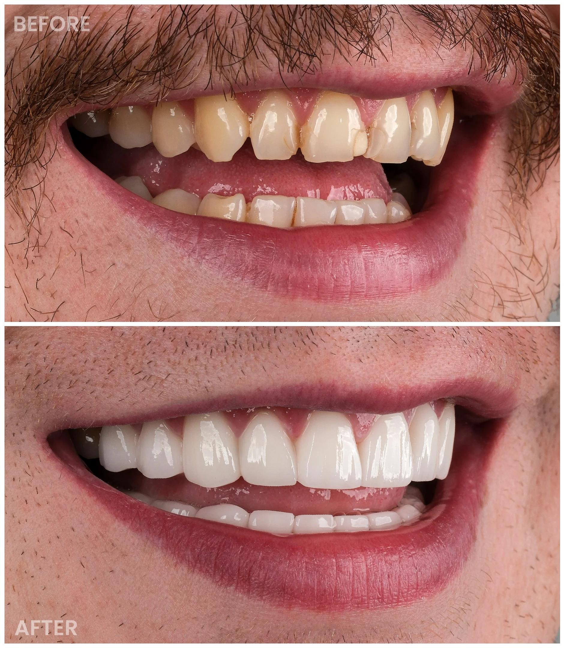 Smile Makeover