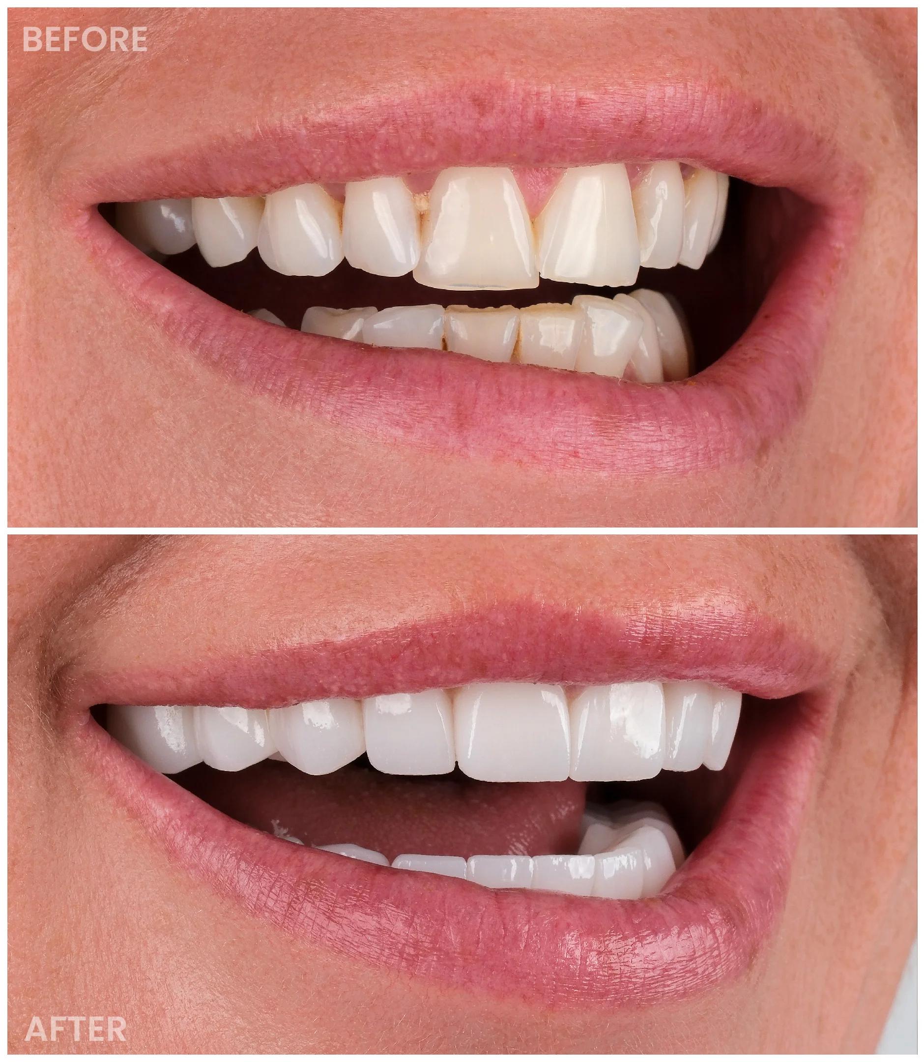 Smile Makeover