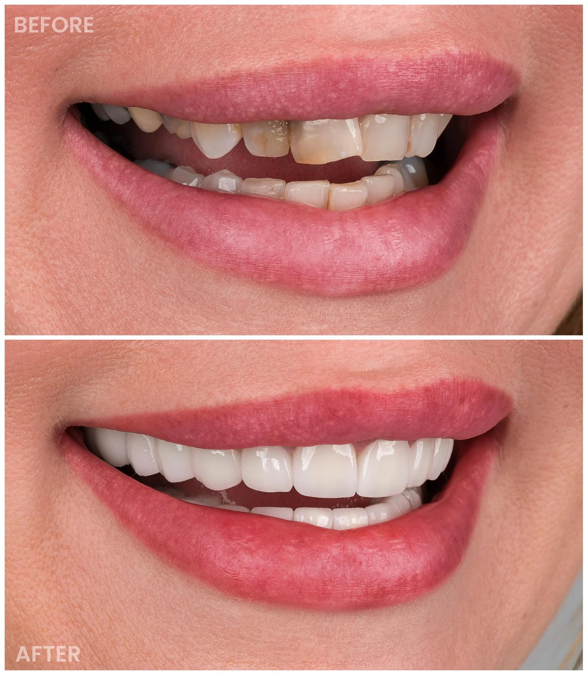 Smile Makeover