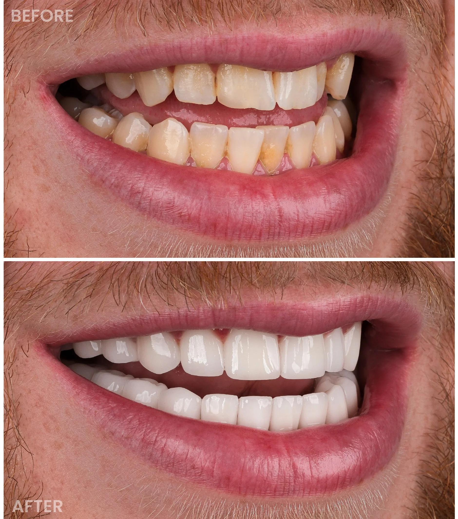 Smile Makeover