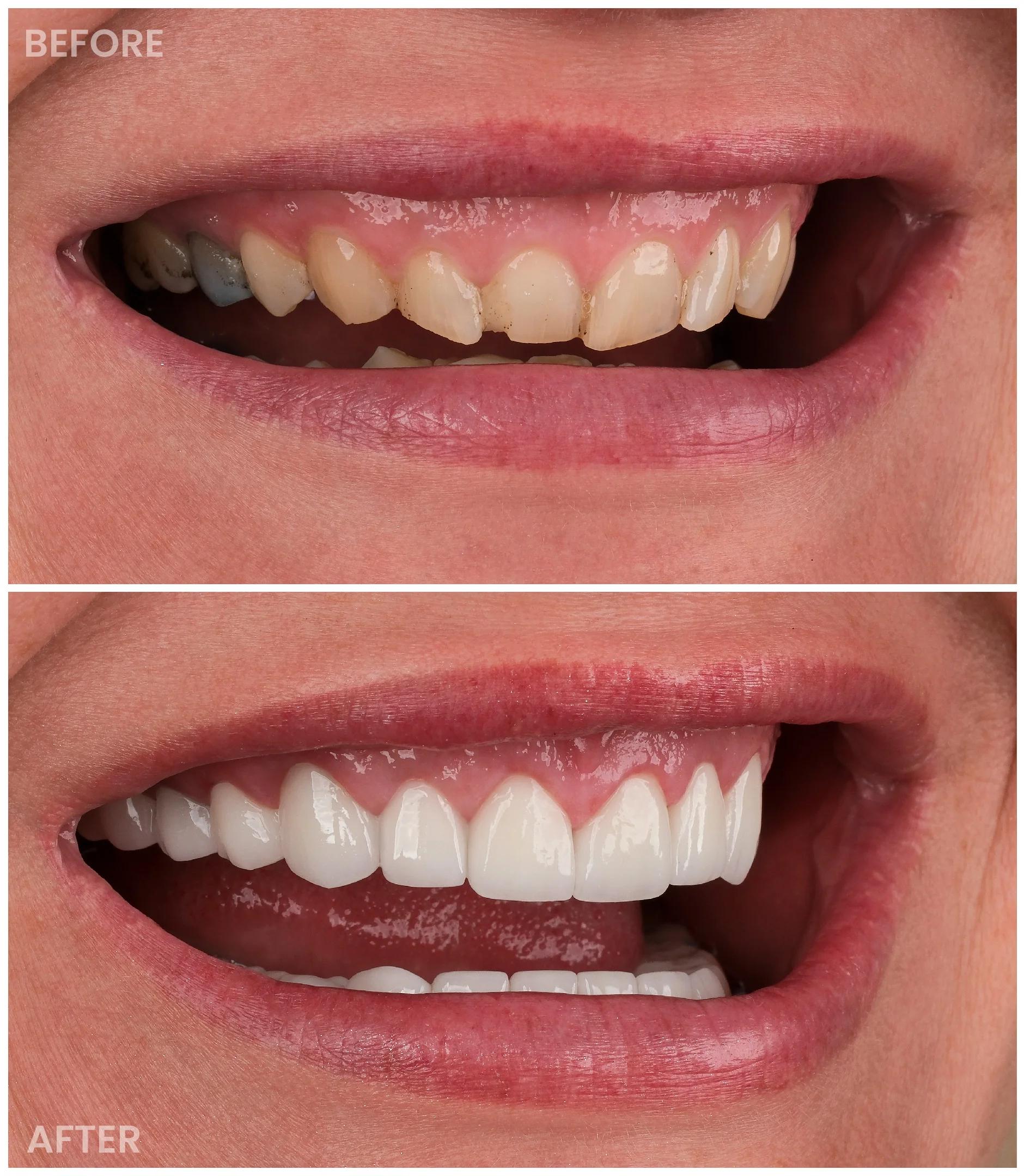 Smile Makeover