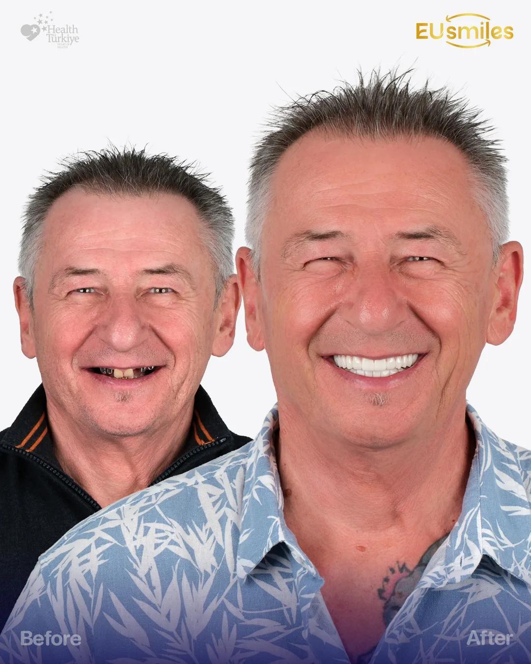 Ezsias A. — Dental Implants