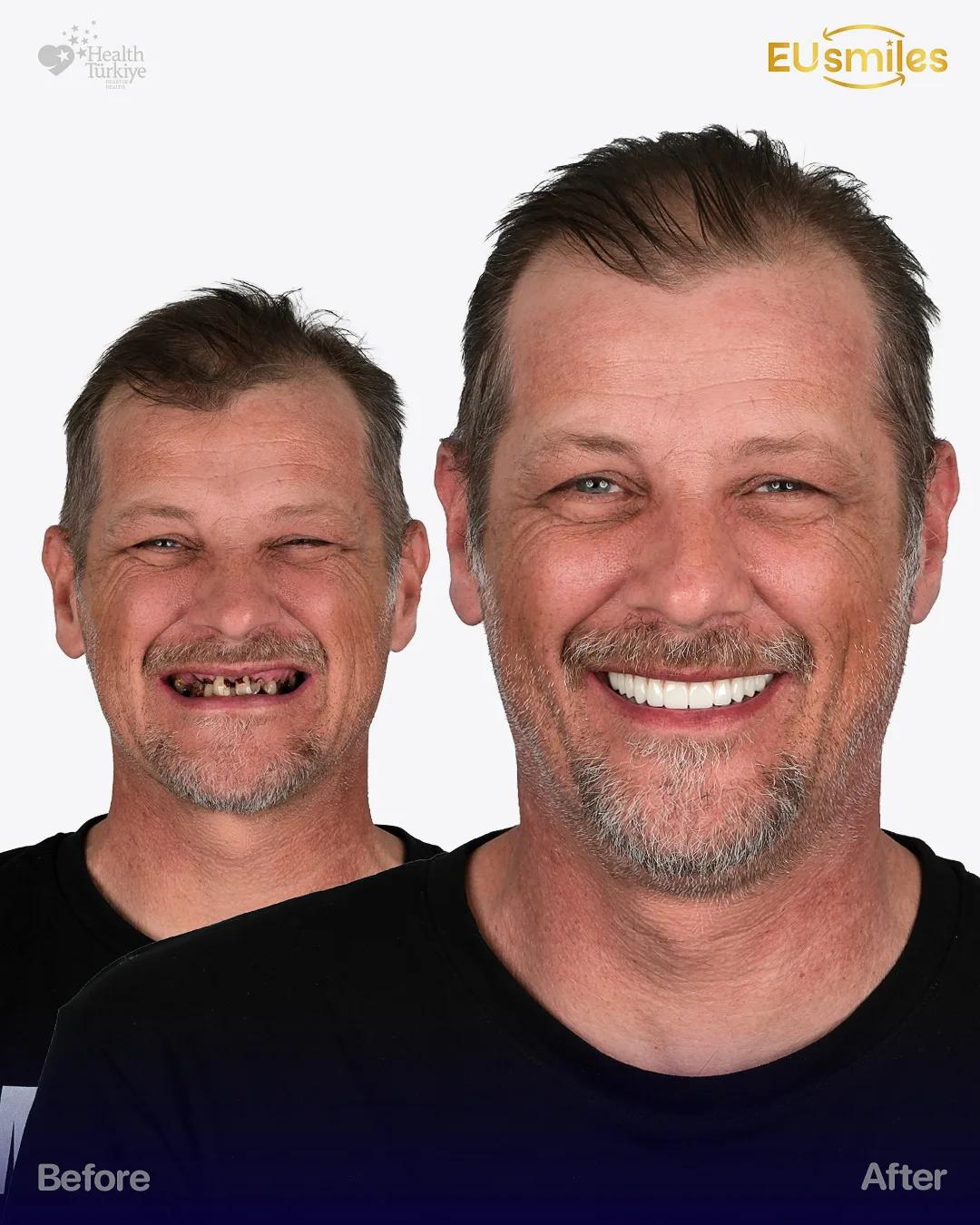 Mathiass K. — Zirconium Crowns
