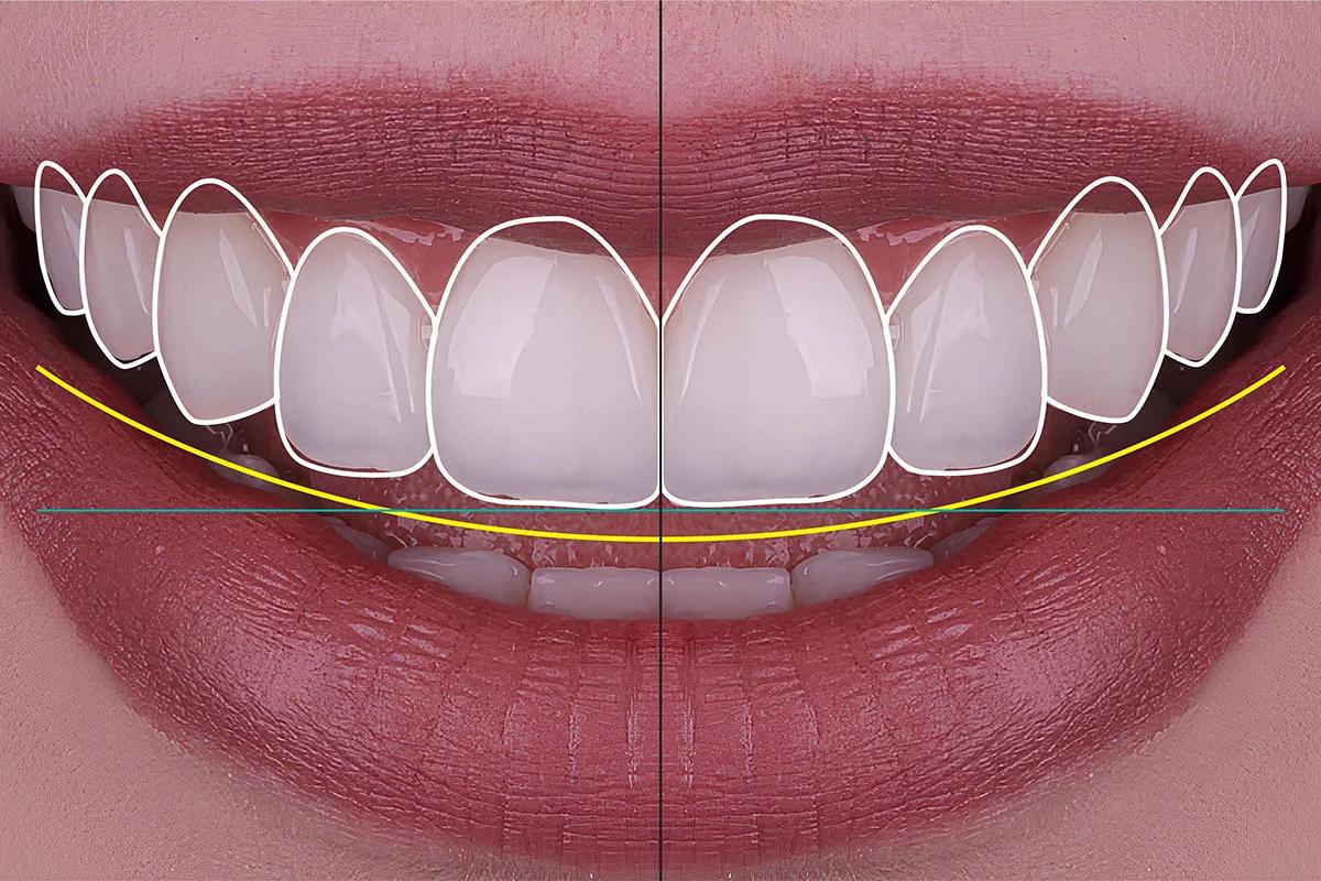 E-max Laminate Veneers in Antalya